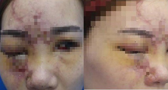 Vụ cô gái nâng mũi bị mù mắt: Những biến chứng kinh hoàng do nâng mũi bằng tiêm filler