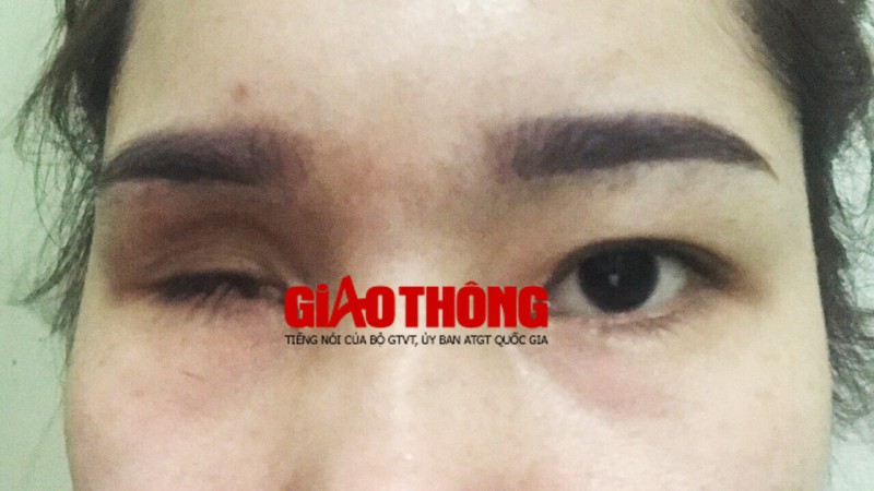 Cô gái Bắc Giang mù vĩnh viễn mù một bên mắt vì nâng mũi bằng tiêm filler