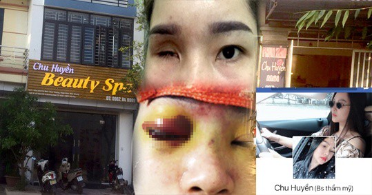 Cô gái Bắc Giang mù vĩnh viễn mù một bên mắt vì nâng mũi bằng tiêm filler