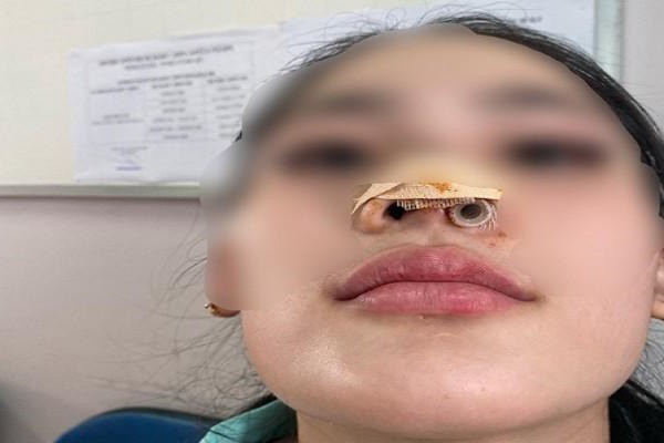 Lỗ mũi thiếu nữ 16 tuổi biến dạng sau khi thẩm mỹ tại spa gần nhà
