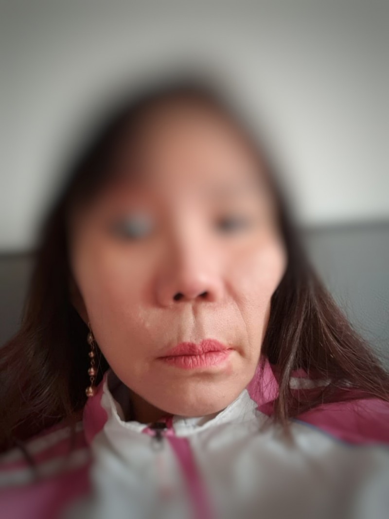 Một bên má bà L bị lõm sâu sau phẫu thuật thẩm mỹ tại Kangnam