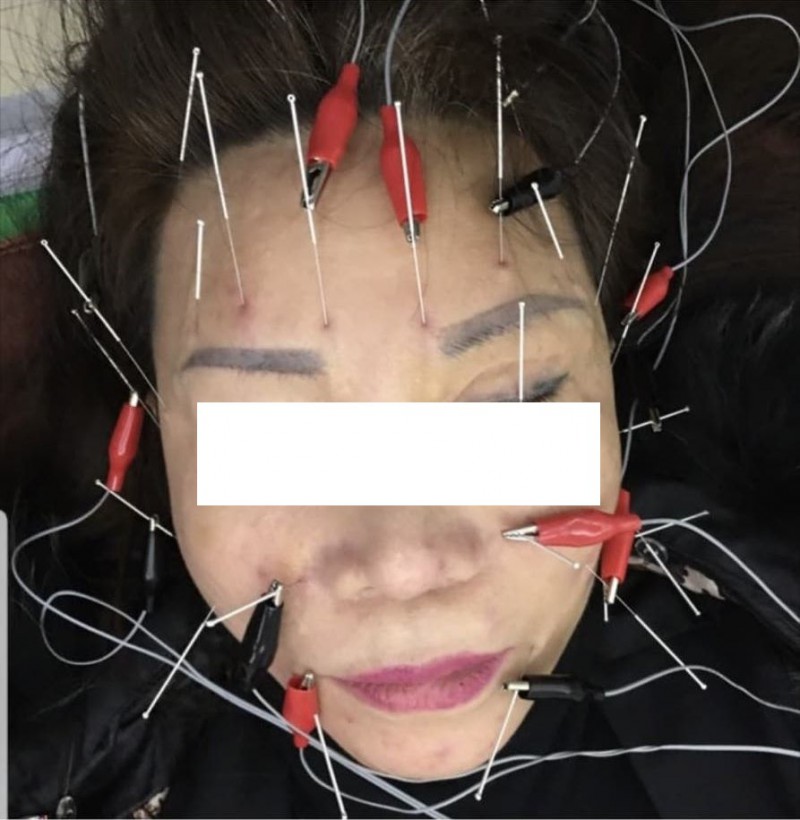 Sau khi phẫu thuật thẩm mỹ tại Kangnam, bà L phải đi châm cứu khắp khuôn mặt