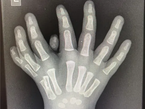 Dị tật hiếm gặp: Bé trai có bàn tay 8 ngón