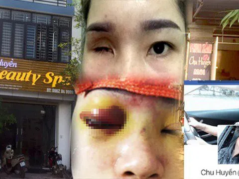 Tâm sự xót xa của cô gái Bắc Ninh vĩnh viễn mù một bên mắt vì nâng mũi bằng tiêm filler