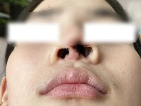 Lỗ mũi thiếu nữ 16 tuổi biến dạng sau khi thẩm mỹ tại spa gần nhà