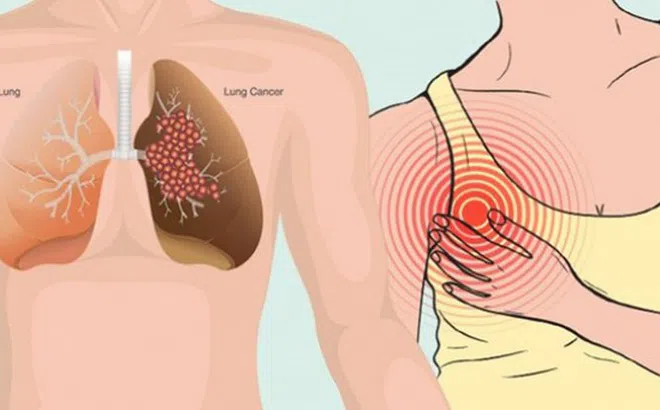 1,6 triệu người chết vì ung thư phổi mỗi năm, đây là những dấu hiệu sớm cảnh báo căn bệnh hiểm này