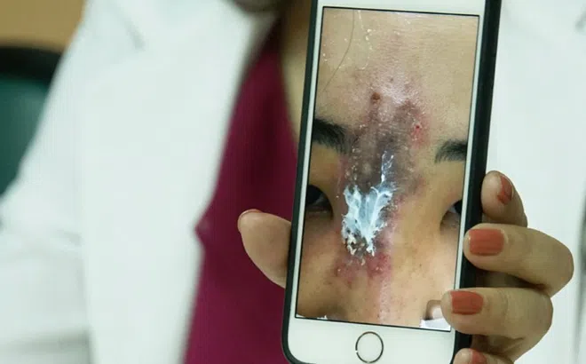 Những ca biến chứng kinh hoàng do tiêm filler nâng mũi: Từ nhiễm trùng, hoại tử đến mù mắt