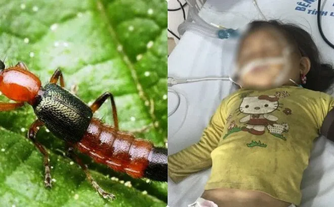 Tin tức sức khỏe mới nhất ngày 14/10/2019: Bị kiến ba khoang đốt xử lý như thế nào?