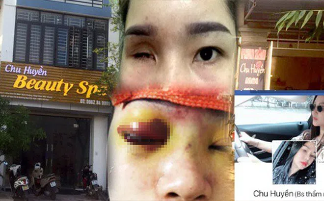 Tâm sự xót xa của cô gái Bắc Ninh vĩnh viễn mù một bên mắt vì nâng mũi bằng tiêm filler