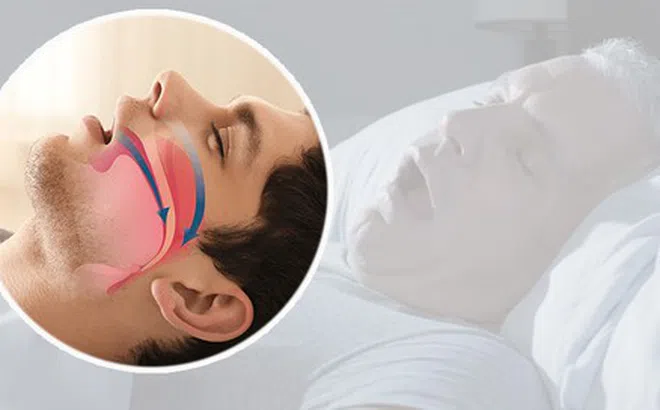 Ngủ ngáy không phải cho 'vui nhà' mà có nguy cơ đột tử, ngừng thở