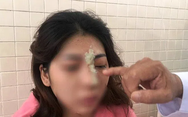 Tiêm filler nâng mũi tại spa, thiếu nữ 21 tuổi bị mù mắt
