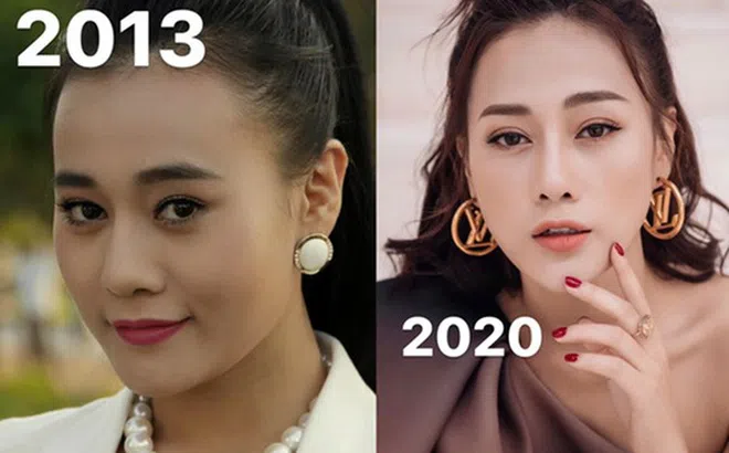 Phương Oanh công khai ảnh trước và sau khi phẫu thuật